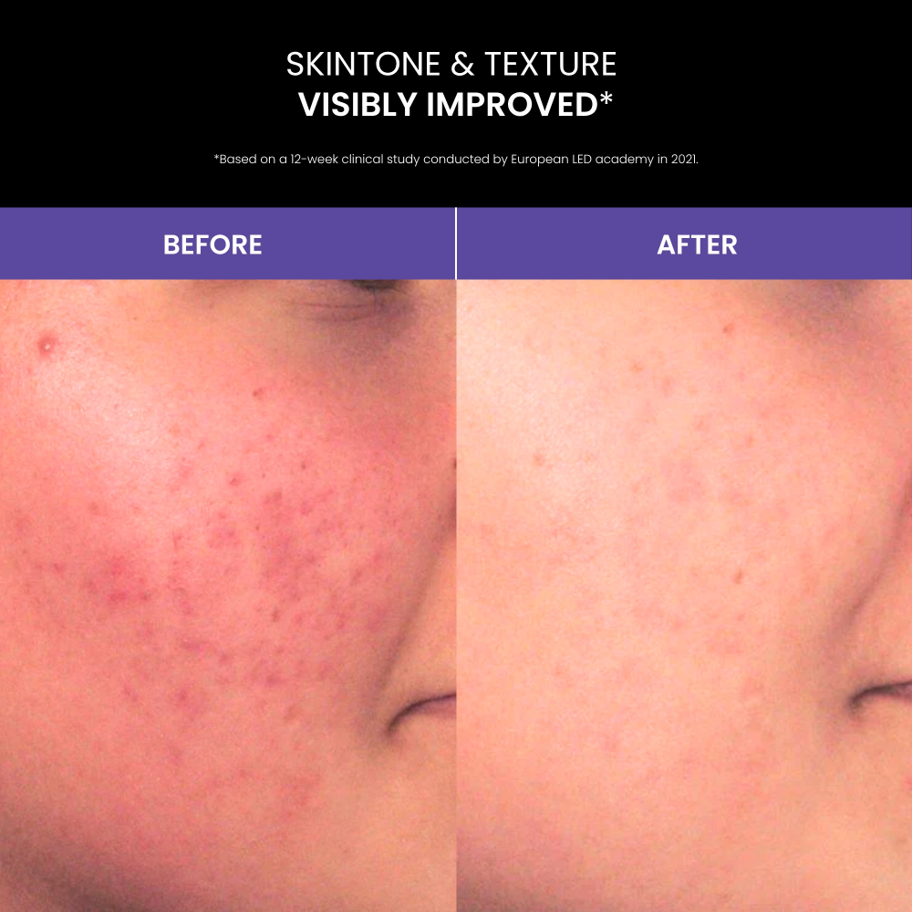 Lustre Solo LED Light Therapy Acne Pod