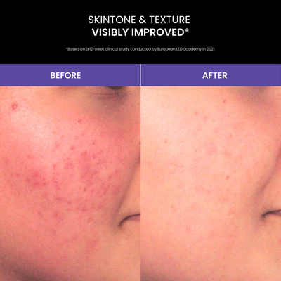 Lustre Solo LED Light Therapy Acne Pod
